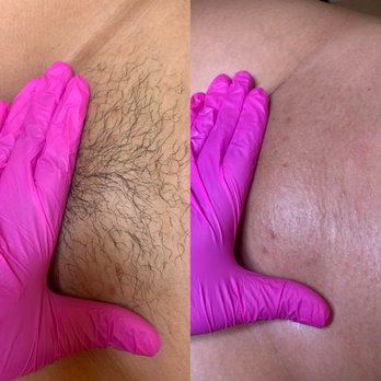 Tampa SKN Studio - Brazilian before & after. - Waxing Near Me - Tampa, Florida Tampa SKN Studio - Brazilian before & after. - Waxing Near Me - Tampa, Florida