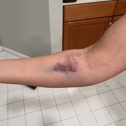 Inova Blood Donor Center - CentreMed - Picture of the arm the next day.