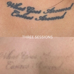 New Life New Image - Before and After of 3 sessions of tattoo removal.