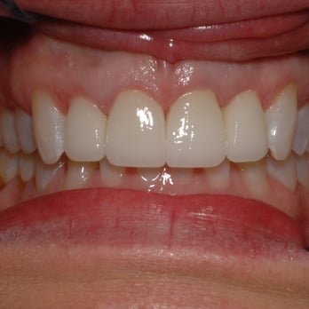 Josey Lane Dentistry - After (4 Upper Veneers) - Cosmetic Dentists Near Me - Carrollton, Texas Josey Lane Dentistry - After (4 Upper Veneers) - Cosmetic Dentists Near Me - Carrollton, Texas