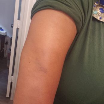 A Real Thai Massage - Bruises from massage less than 24 hours afterwards - Massage Therapy Near Me - Houston, Texas