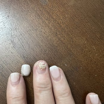Fleur Nail Spa - What my nail looks like when the tip came off. - Nail Salons Near Me - North Palm Beach, Florida Fleur Nail Spa - What my nail looks like when the tip came off. - Nail Salons Near Me - North Palm Beach, Florida