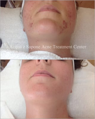 AES Acne Clinic by null