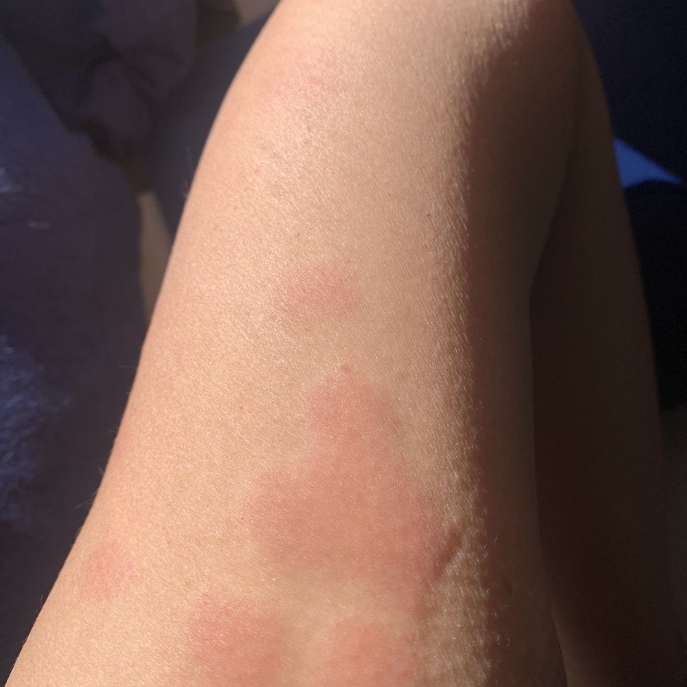 Wyndham Stuttgart Airport Messe - Bed bug bites marks from this hotel after staying there one night before departure - Hotels Near Me - Stuttgart, BW