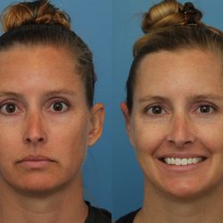 OTOPLASTY (EAR SURGERY) BY DR. CAMERON FRANCIS