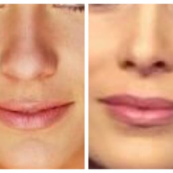 My Bulbous Nose Tip And Top Hair Lip Before And After Tiplasty
