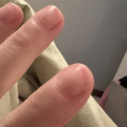 Heart's Nail Spa - Ring of fire on broken tips and middle of fingers