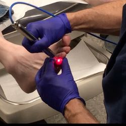 Mark Forman, Dpm - Laser Therapy for Nail Fungus