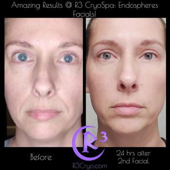 R3 Vitality - Endospheres Facial
Before & 24hrs post facial. What a difference! - Medical Spas Near Me - Cedar Park, Texas R3 Vitality - Endospheres Facial
Before & 24hrs post facial. What a difference! - Medical Spas Near Me - Cedar Park, Texas