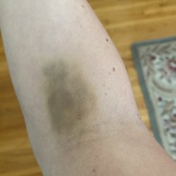 Quest Diagnostics - Look at this bruise a week after the blood draw. ZERO excuses for this!