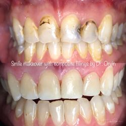 The Tooth Doctor - Dr Orvin transformed this patient's smile with composite fillings.
