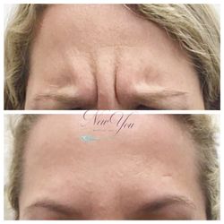 New You Medical Spa - Botox frown lines/11's