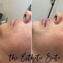The Esthetic Suite - Needleless lip filler