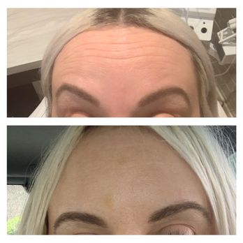 Everything Esthetics - Before and 5 days after - Permanent Makeup Near Me - Sacramento, California