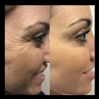 Uzuri Allure - Before and after of client using Botox Injections to relax the muscles causing her wrinkles. - Eyelash Service Near Me - Covina, California Uzuri Allure - Before and after of client using Botox Injections to relax the muscles causing her wrinkles. - Eyelash Service Near Me - Covina, California