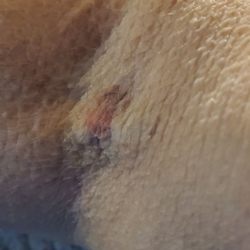 Hartsdale Imaging - Bruise on my mid-arm (opposite elbow) where they normally draw blood from or insert an IV.