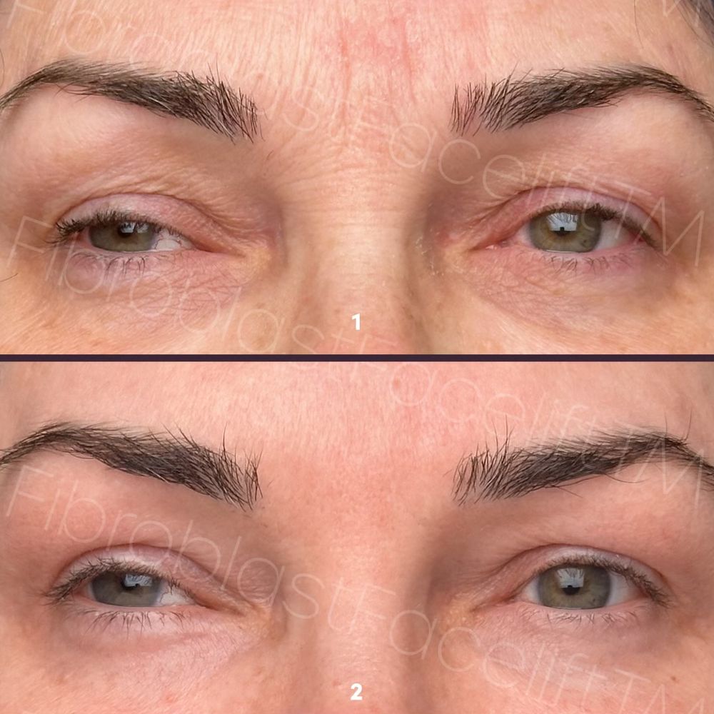 Fibroblast Facelift - Skin Care Near Me - Pasadena, California