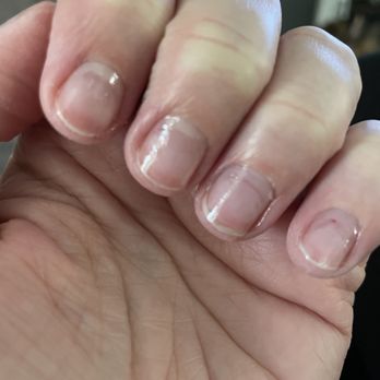 Sassy Nails - You can see the redness at the top and the white at the cuticle where my nail is finally growing back. - Nail Salons Near Me - Las Vegas, Nevada