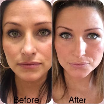 Le Beau Visage - Before & after my Botox session - Medical Spas Near Me - Frisco, Texas Le Beau Visage - Before & after my Botox session - Medical Spas Near Me - Frisco, Texas
