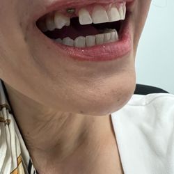 Humphries Orthodontics - Abutment