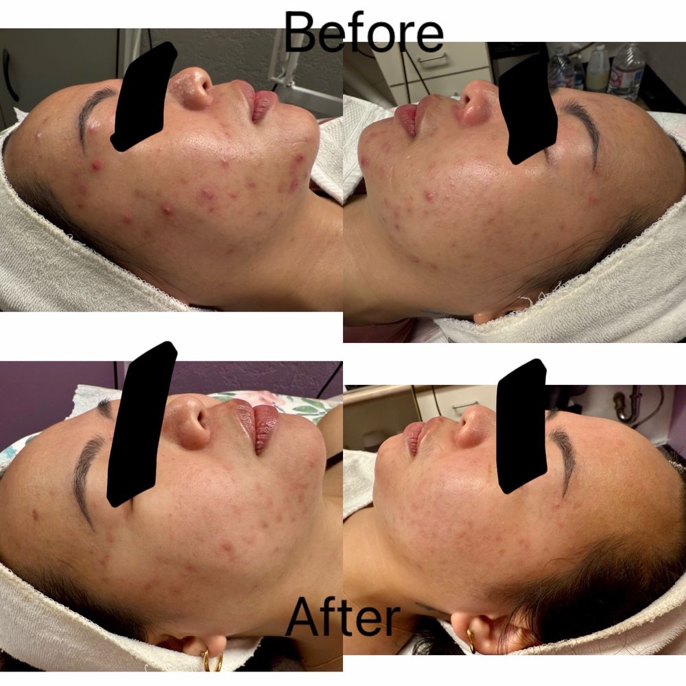 Acne Solutions Skin Care & Spa Logo