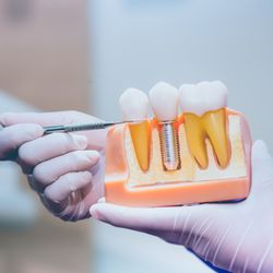 Bedrock Dentistry - We are Dental Implant Specialists from extraction, implants to restoration. Single implants, Implant bridges, Implant dentures and All on X