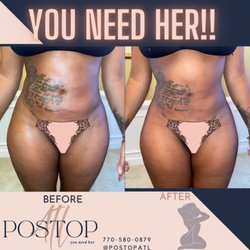 PostOp Atl