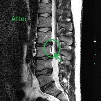 Valley Spinal Decompression Center - Post treatment MRI showing restoration of previously herniated lumbar disc. - Chiropractors Near Me - Encino, California Valley Spinal Decompression Center - Post treatment MRI showing restoration of previously herniated lumbar disc. - Chiropractors Near Me - Encino, California