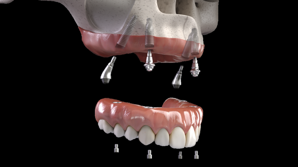 Quality Tooth Restoration Options - Once we've determined that dental implants are the right choice for your needs, we can offer a variety of restoration options. Our tooth implants are created with efficiency and authenticity in mind, evaluating your current condition before recommending which selection will be the best choice for your needs. Our placement procedure is performed using computer-guided technology for optimal preciseness. The dental restoration services we offer include:

Dental Crowns: Dental crowns are prosthetic caps designed in a lab to replace a single tooth when placed onto an implant post. Our personalized crowns boast a natural appearance by matching the color, shape, and size of your adjacent teeth and will fit your unique oral structure.
Dental Bridges: Bridges replace several missing teeth in a row using a single prosthetic. This procedure involves firmly positioning two crowns on either side of the gap with one prosthetic tooth suspended in the middle. A dental bridge is a convenient method to rejuvenate your smile while also preventing healthy adjacent teeth from shifting out of alignment.
Dental Dentures: We can offer full or partial dentures, which act as a lifelike dental replacement for multiple missing teeth and the surrounding tissue. Dentures are a convenient and reliable dental device for restoring your smile in one piece or for replacing a segment of your smile while keeping adjacent teeth from shifting out of place.
All-on-4®: We are proud to offer the All-on-4 dental implant technique. This procedure involves placing four implant posts to completely rehabilitate an entire arch of missing teeth. The four implant posts will be strategically placed using our advanced diagnostic capabilities. For patients who qualify, we will pinpoint where ample jawbone density exists in your mouth for a placement that boasts continued durability after years of repeated use.