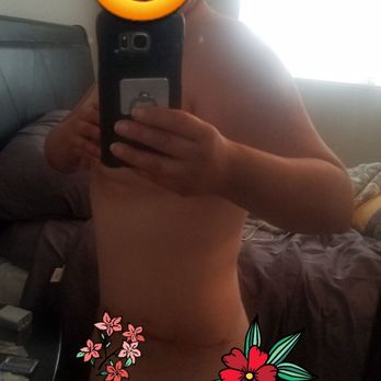 Ronald J Edelson, MD - 5 weeks after extended tummy tuck - Cosmetic Surgeons Near Me - San Diego, California Ronald J Edelson, MD - 5 weeks after extended tummy tuck - Cosmetic Surgeons Near Me - San Diego, California