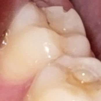 Duckfat - This is my CHIPPED TOOTH from the sandwich!!!! - New American Near Me - Portland, Maine Duckfat - This is my CHIPPED TOOTH from the sandwich!!!! - New American Near Me - Portland, Maine