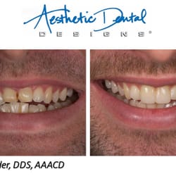 Todd Snyder, DDS - Bonding on the front two teeth.