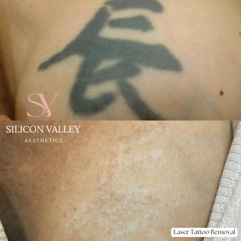 Silicon Valley Aesthetics - Get rid of unwated ink with Laser Tattoo Removal! - Weight Loss Centers Near Me - San Jose, California Silicon Valley Aesthetics - Get rid of unwated ink with Laser Tattoo Removal! - Weight Loss Centers Near Me - San Jose, California