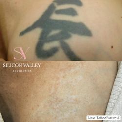 Silicon Valley Aesthetics - Get rid of unwated ink with Laser Tattoo Removal!