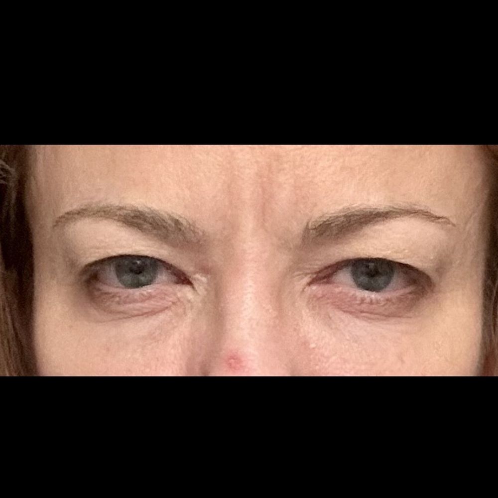 My Botox LA Med Spa - After... decide for your self - Skin Care Near Me - Studio City, California My Botox LA Med Spa - After... decide for your self - Skin Care Near Me - Studio City, California