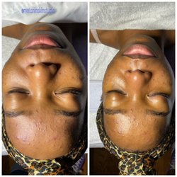 Melanin Skin Studio - Acne Facials available..