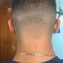 My son got an outbreak after his visit.