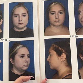 FACEOLOGYMD - Dr. Raymond Lee - Before surgery and about 6 weeks after - Medical Spas Near Me - Newport Beach, California