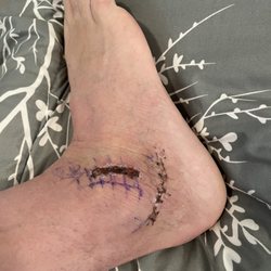 Summit Foot and Ankle Specialists - Healing