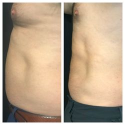Joie De Vivre MedSpa of Chattanooga - Lose the extra fat while tightening & sculpting your body- schedule an appointment and see what's possible!