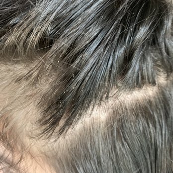 DELYCE - This is before treatment. You can see a colony of nits (eggs) around the scalp. - Lice Services Near Me