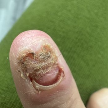 Topline Nails and Lashes - 3 nails now infected - Nail Salons Near Me - Pico Rivera, California Topline Nails and Lashes - 3 nails now infected - Nail Salons Near Me - Pico Rivera, California