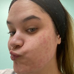 BodyBrite - Microneedling
