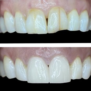 TLC Escondido Dental - Before and After 2 front crowns - Oral Surgeons Near Me - Escondido, California TLC Escondido Dental - Before and After 2 front crowns - Oral Surgeons Near Me - Escondido, California