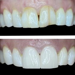 TLC Escondido Dental - Before and After 2 front crowns