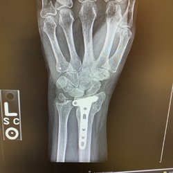 Kautz Shore Lanes - Plate in my shattered wrist!