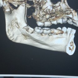Malmquist Oral and Maxillofacial Surgery - Transected Lingual Plate