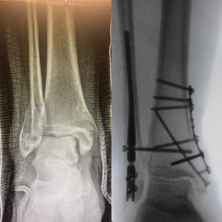 The Foot and Ankle Sports Institute - Ankle fracture