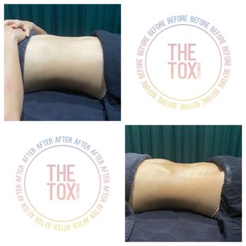 The Tox - Before and after - Skin Care Near Me - Studio City , California
