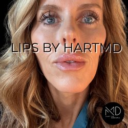 Hart MD MedSpa - Filler by Dr. Hart.